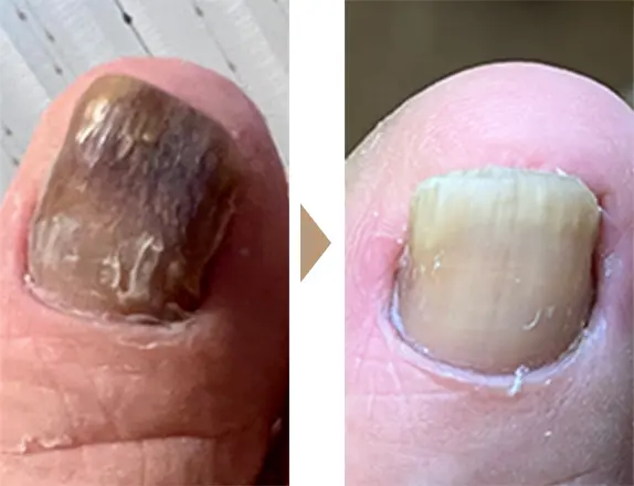肥厚・剥離のあった爪を削り、クリーニングを行った施術前後の画像