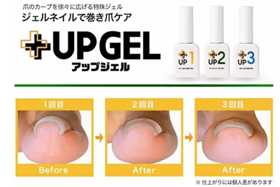巻き爪・陥入爪のケアに使用する巻き爪ケアジェル