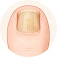 肥厚爪のイラスト