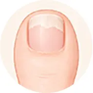 爪甲剥離のイラスト
